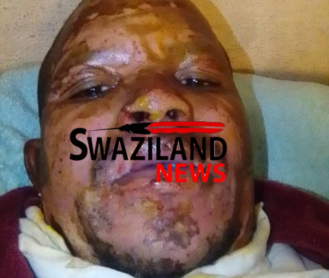 Mbabane mechanic Wonder Gama sprayed with petrol on the face by Mswati’s police,set alight for traveling at night.