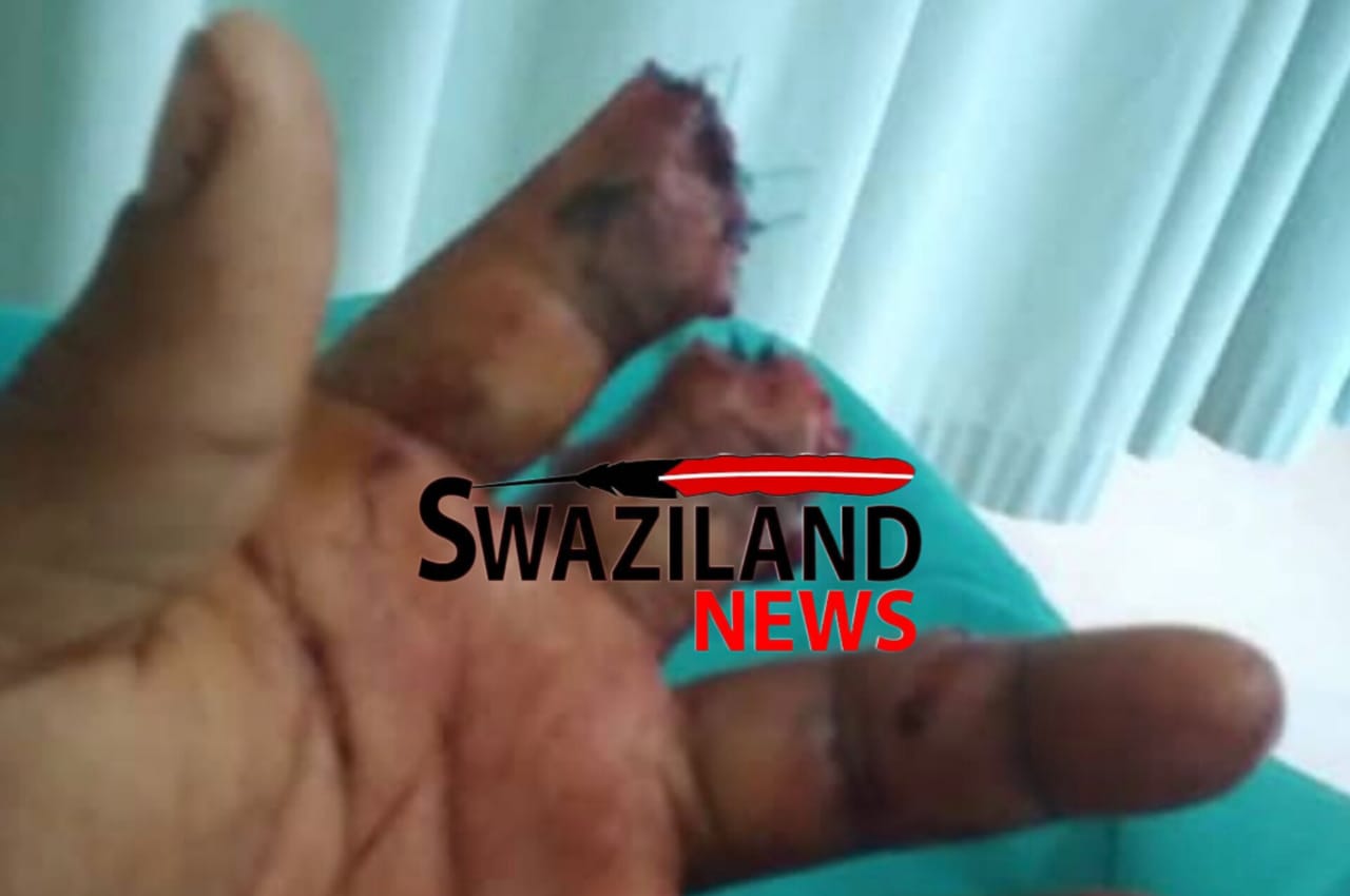 Rocklands Sawmill employee Mbongiseni Zikalala injured and lost fingers on duty,company ‘fires’ him with mere R10,000.00 compensation.