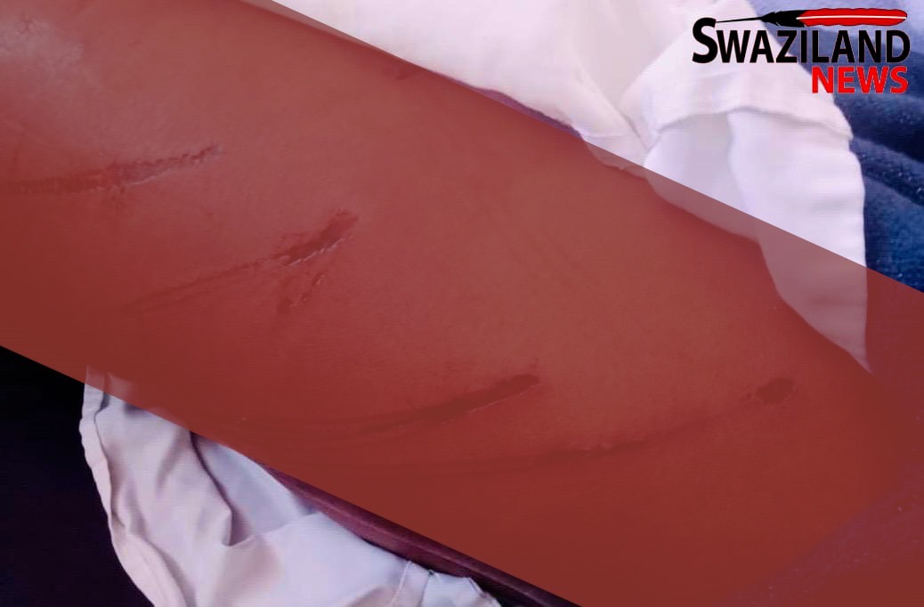 Hhukwini Community Police(emaphoyisa emmango), heavily assault sixteen(16) year-old boy for allegedly breaking into ex-MP Saladin Magagula’s grocery shop,suspect in a critical condition at Mbabane Government Hospital.