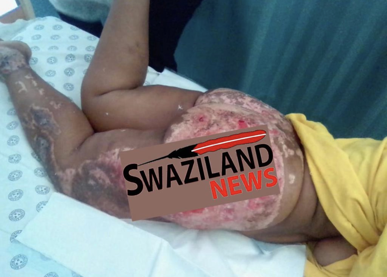 Political unrest victim who was ‘burnt’ by Mswati’s soldiers urgently need medical attention.